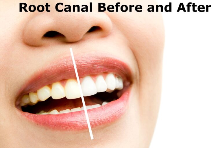 Root Canal Before and After: Causes, Symptoms, Procedure and Recovery